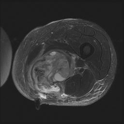 MFH Thigh MRI Axial